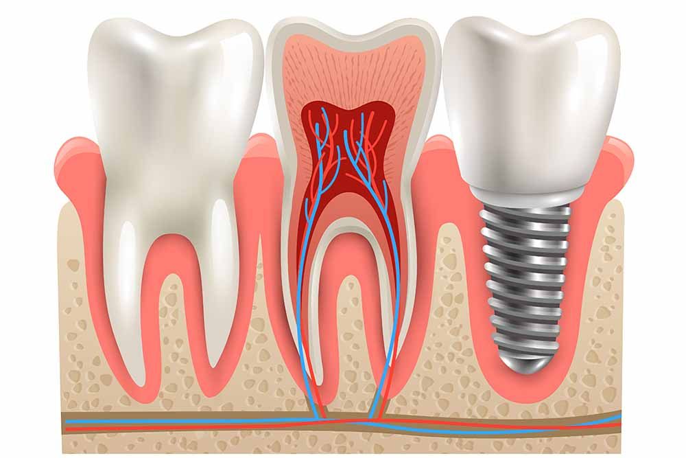 Invisible braces in Pondicherry using transparent clear aligners for discreet teeth straightening