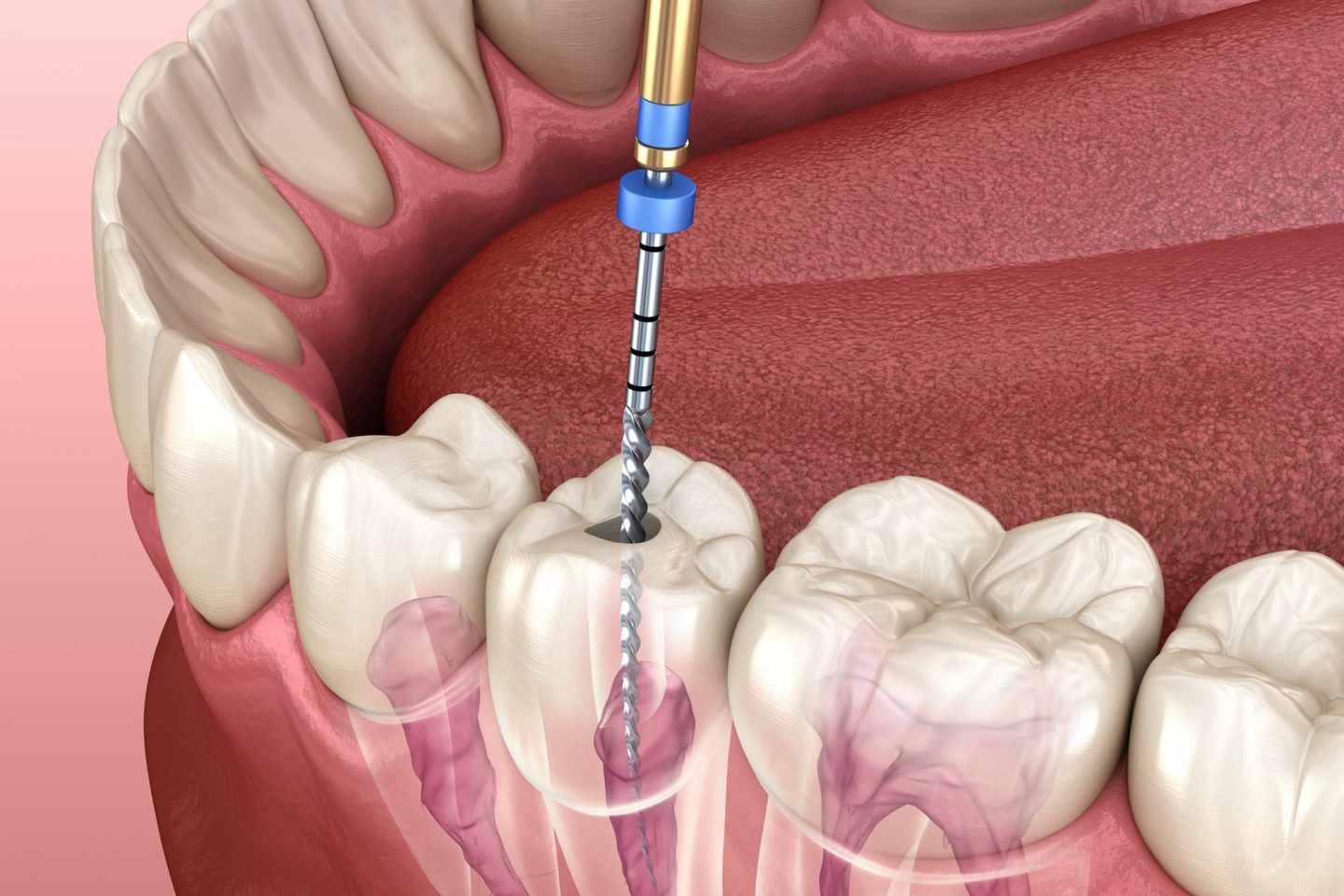 Teeth alignment treatment in Pondicherry for crooked crowded and spaced teeth