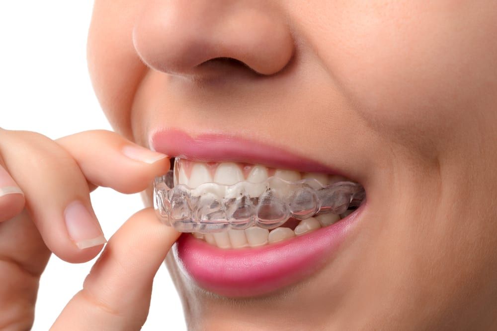 Aligners & Implants