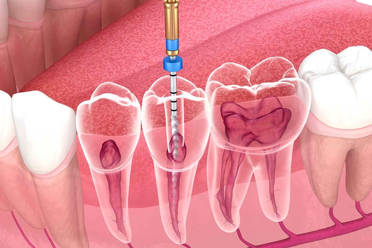 Endodontic Dentistry