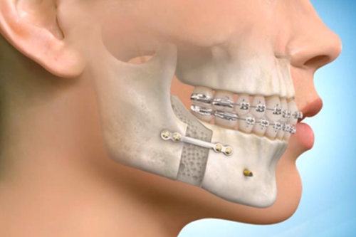  smilekraft orthognathic surgery