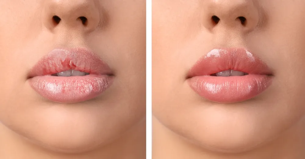 Lip Pigmentation